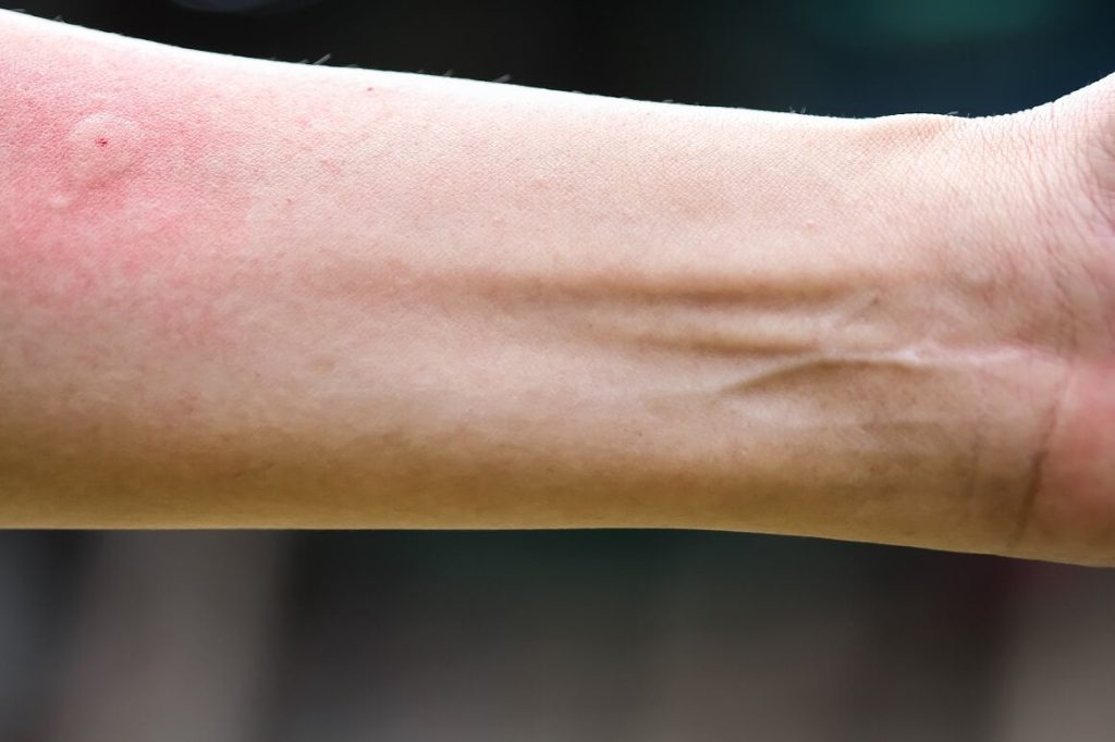 Ispovijest muškarca kojeg je napao roj stršljena ledi krv u žilama
