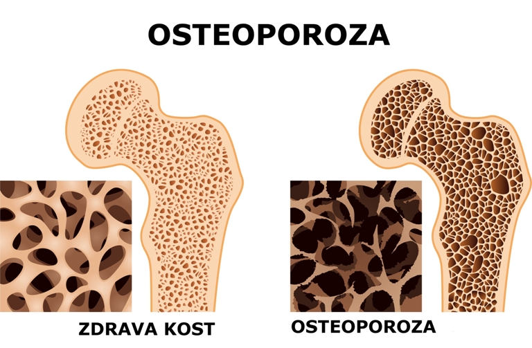 Zaustavite osteoporozu dok još možete: Ishrana koja spašava kosti u menopauzi!