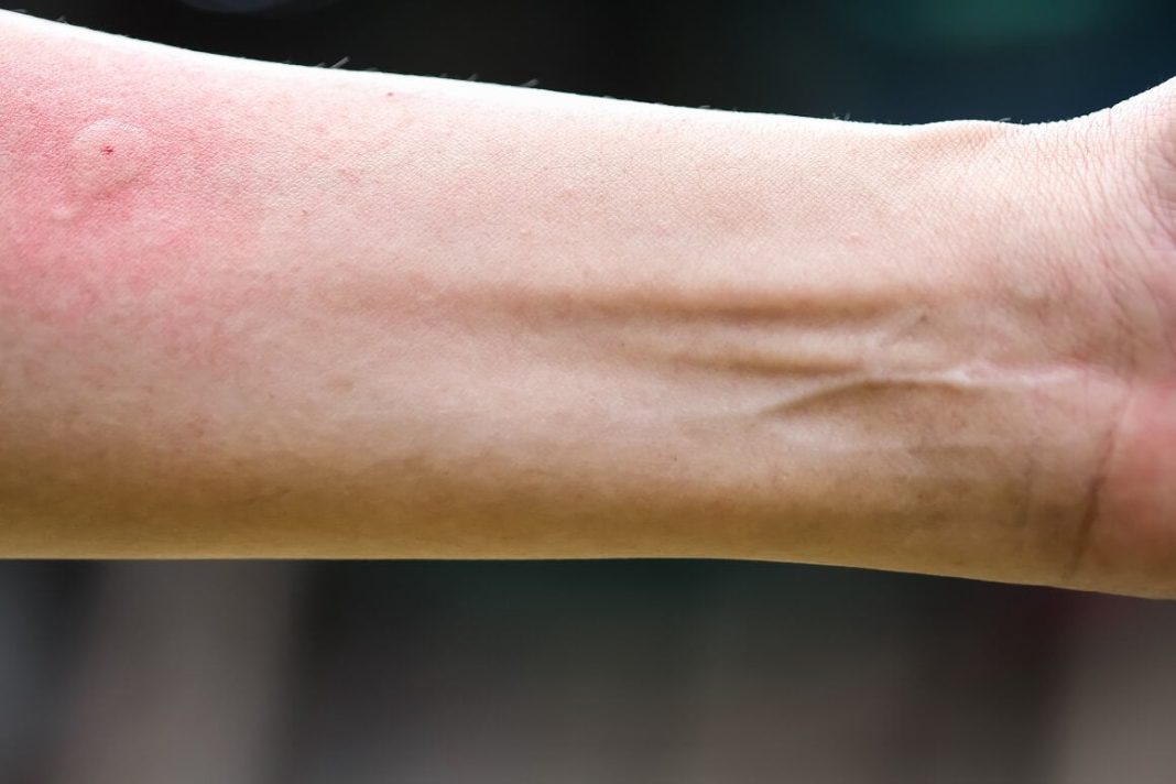Ispovijest muškarca kojeg je napao roj stršljena ledi krv u žilama