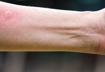 Ubod stršljena ga odveo na rub smrti,Ispovijest muškarca kojeg je napao roj stršljena ledi krv u žilama: “Srce mi je prestalo kucati, ali čudo me vratilo! Ispovijest muškarca kojeg je napao roj stršljena ledi krv u žilama