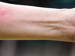 Ubod stršljena ga odveo na rub smrti,Ispovijest muškarca kojeg je napao roj stršljena ledi krv u žilama: “Srce mi je prestalo kucati, ali čudo me vratilo! Ispovijest muškarca kojeg je napao roj stršljena ledi krv u žilama