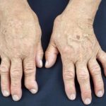 Jedan od glavnih uzroka reume nalazi se u ovoj namirnici: Sadrži opasnu bakteriju koja ubrzava ovu bolest