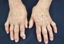 Jedan od glavnih uzroka reume nalazi se u ovoj namirnici: Sadrži opasnu bakteriju koja ubrzava ovu bolest