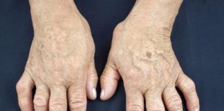 Jedan od glavnih uzroka reume nalazi se u ovoj namirnici: Sadrži opasnu bakteriju koja ubrzava ovu bolest