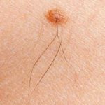 Iz mladeža vam raste dlaka? Evo šta to znači i kako da prepoznate da je opasan po zdravlje – vodite računa