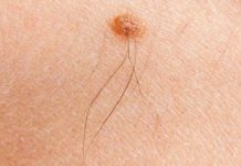 Iz mladeža vam raste dlaka? Evo šta to znači i kako da prepoznate da je opasan po zdravlje – vodite računa