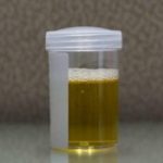 Boja urina otkriva mnoge bolesti, čak i najteže: Ako vam je mokraća mutna, to znači samo jedno