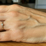 Zašto Su Vam Vene Odjednom Vidljivije? Uzroci, Savjeti i Kada Potražiti Pomoć