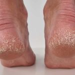 Jedan jeftin sastojak jedini je lek za ispucale pete, gljivice i kurje oko: Pravo je blago u kući