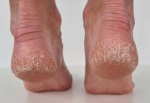 Jedan jeftin sastojak jedini je lek za ispucale pete, gljivice i kurje oko: Pravo je blago u kući