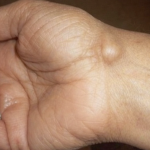 Imate li ovakve izrasline: evo kako da ih se riješite preko noćI