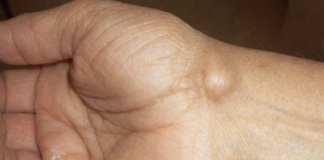 Imate li ovakve izrasline: evo kako da ih se riješite preko noćI