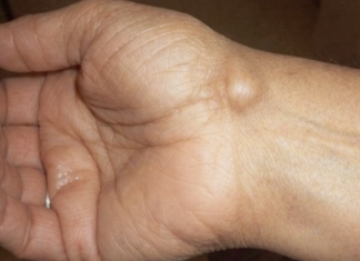 Imate li ovakve izrasline: evo kako da ih se riješite preko noćI