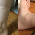 Kad skinete čarape ostanu vam tragovi na nogama: evo šta se dešava sa vašim zdravljem