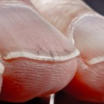 Da li vaši nokti izgledaju ovako? Ova promjena može ukazivati na ozbiljan problem s plućima!