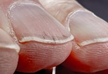 Da li vaši nokti izgledaju ovako? Ova promjena može ukazivati na ozbiljan problem s plućima!