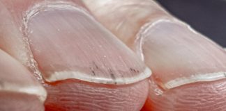 Da li vaši nokti izgledaju ovako? Ova promjena može ukazivati na ozbiljan problem s plućima!