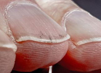 Da li vaši nokti izgledaju ovako? Ova promjena može ukazivati na ozbiljan problem s plućima!