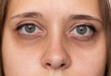 Podočnjaci nisu samo od umora i nespavanja: Evo šta vam telo zapravo poručuje i kako ih ublažiti