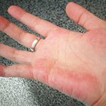 AKO IMATE CRVENE DLANOVE, ODMAH IZVADITE KRV: Ovaj simptom upozorava da vam jedan organ otkazuje