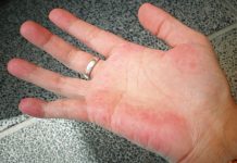 AKO IMATE CRVENE DLANOVE, ODMAH IZVADITE KRV: Ovaj simptom upozorava da vam jedan organ otkazuje