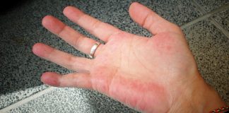 AKO IMATE CRVENE DLANOVE, ODMAH IZVADITE KRV: Ovaj simptom upozorava da vam jedan organ otkazuje