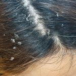 Imate li problema sa peruti? Ovo je najefikasnije rješenje za kojim su svi poludjeli!