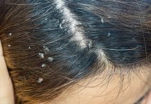 Imate li problema sa peruti? Ovo je najefikasnije rješenje za kojim su svi poludjeli!