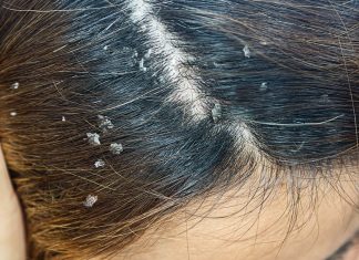 Imate li problema sa peruti? Ovo je najefikasnije rješenje za kojim su svi poludjeli!