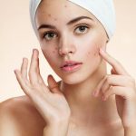 Mjesto prištića otkriva uzrok: Muči li vas probava ili hormoni