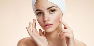 Mjesto prištića otkriva uzrok: Muči li vas probava ili hormoni