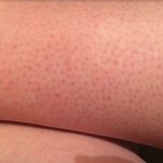 OVE TAČKICE NA NOGAMA VAM KVARE LJETO? Evo kako da ih se riješite, koža će vam biti glatka