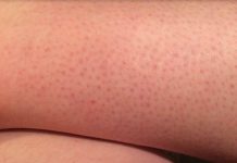 OVE TAČKICE NA NOGAMA VAM KVARE LJETO? Evo kako da ih se riješite, koža će vam biti glatka