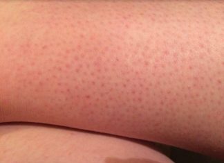 OVE TAČKICE NA NOGAMA VAM KVARE LJETO? Evo kako da ih se riješite, koža će vam biti glatka