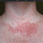 Primetili ste ovakve promjene na licu ili vratu: Doktor otkriva, evo šta se dešava sa vama