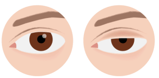 Spušteni kapak i nepodnošljiva glavobolja: Oprez, doktori upozoravaju na 2 alarmantna znaka opasnog stanja