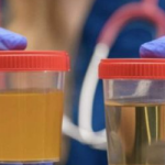 BOJA URINA otkriva mnoge ozbiljne bolesti, pa čak i one NAJTEŽE – Ovo je RAZLOG mutne mokraće!