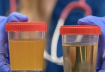 BOJA URINA otkriva mnoge ozbiljne bolesti, pa čak i one NAJTEŽE – Ovo je RAZLOG mutne mokraće!