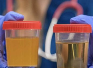 BOJA URINA otkriva mnoge ozbiljne bolesti, pa čak i one NAJTEŽE – Ovo je RAZLOG mutne mokraće!