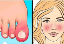 10 Znakova AUTOIMUNIH BOLESTI kod kojih tijelo samo sebe uništava