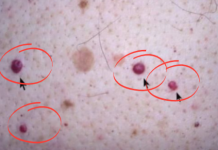 IMATE LI OVE CRVENE TAČKICE NA TIJELU? To nisu popucali kapilari, EVO O ČEMU SE ZAISTA RADI