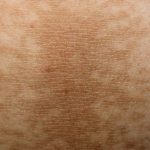 Simptomi DIJABETESA koji se javljaju i prije njegovog početka! 9 signala koje nikada ne biste trebali zanemariti