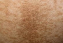 Simptomi DIJABETESA koji se javljaju i prije njegovog početka! 9 signala koje nikada ne biste trebali zanemariti