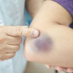 Primijetili ste da vam lako ostaju modrice na tijelu? Evo šta mogu biti uzroci