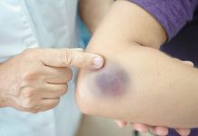 Primijetili ste da vam lako ostaju modrice na tijelu? Evo šta mogu biti uzroci