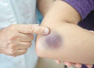 Primijetili ste da vam lako ostaju modrice na tijelu? Evo šta mogu biti uzroci