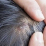 BUBULJICE NA GLAVI SU SVE ČEŠĆI PROBLEM: Ni slučajno ih ne istiskujte, evo zašto se javljaju I ŠTA TREBATE URADITI DA NESTANU