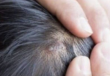 BUBULJICE NA GLAVI SU SVE ČEŠĆI PROBLEM: Ni slučajno ih ne istiskujte, evo zašto se javljaju I ŠTA TREBATE URADITI DA NESTANU