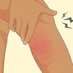 Evo kako na vrijeme možete prepoznati da imate krvni ugrušak