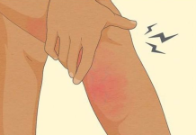 Evo kako na vrijeme možete prepoznati da imate krvni ugrušak